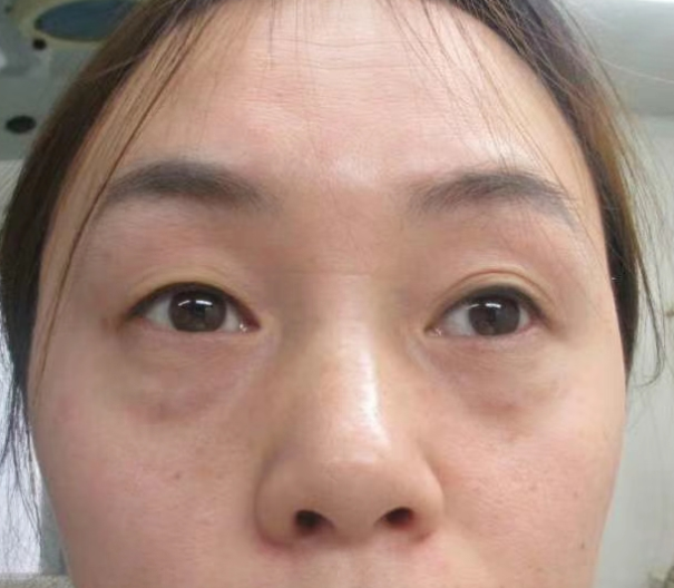 去眼袋手术