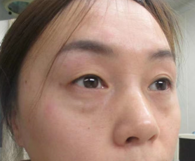 去眼袋手术