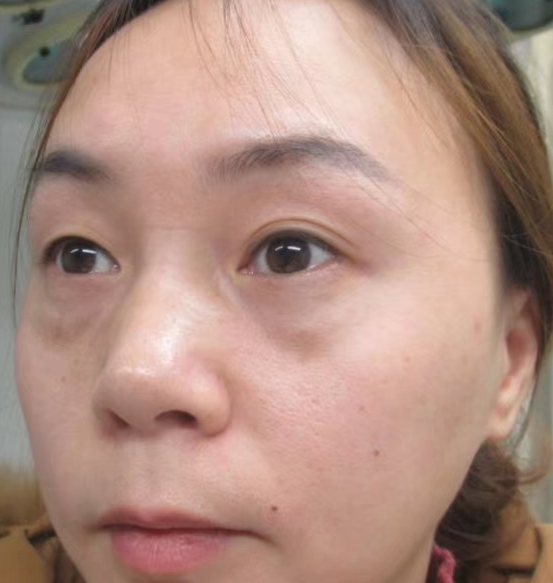 去眼袋手术