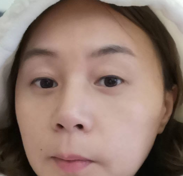 去眼袋手术