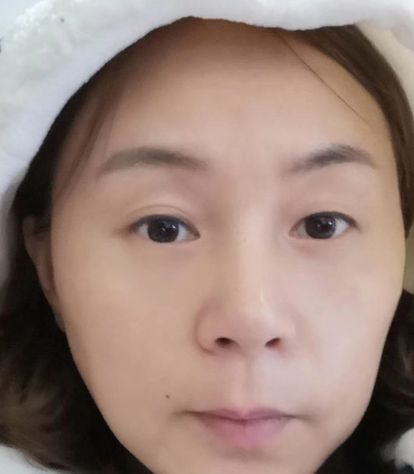 去眼袋手术
