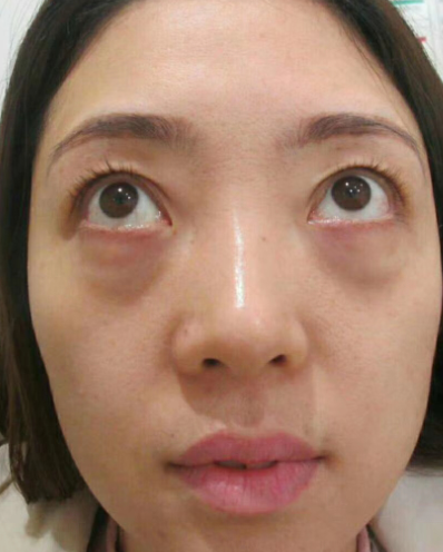 去眼袋手术