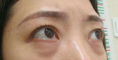去眼袋手术