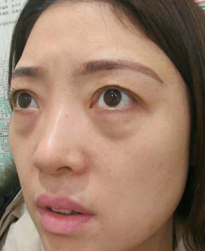 去眼袋手术