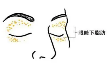 去眼袋手术