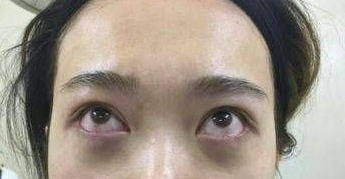 去眼袋手术