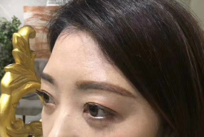 去眼袋手术
