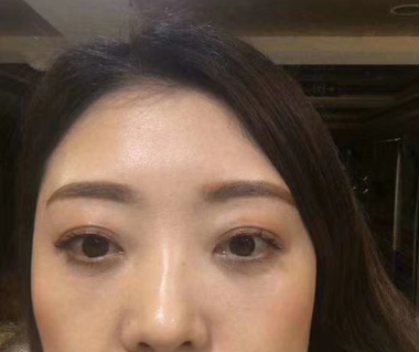 去眼袋手术