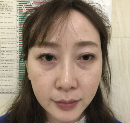 去眼袋手术