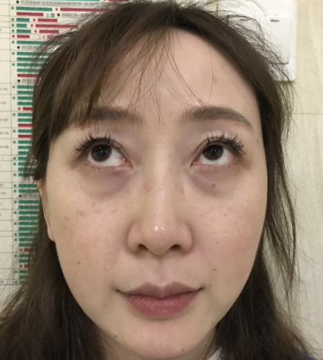 去眼袋手术
