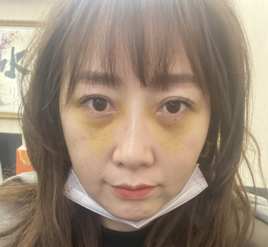 去眼袋手术
