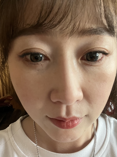 去眼袋手术