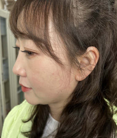 去眼袋手术