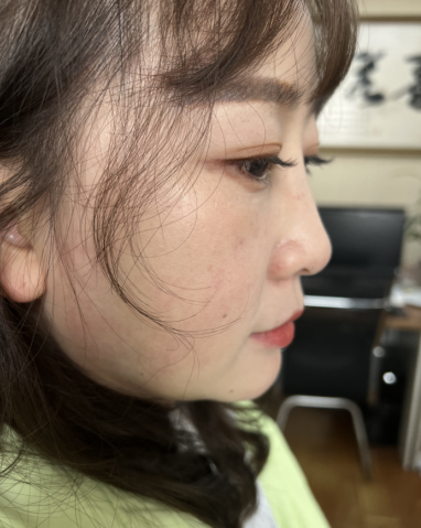 去眼袋手术