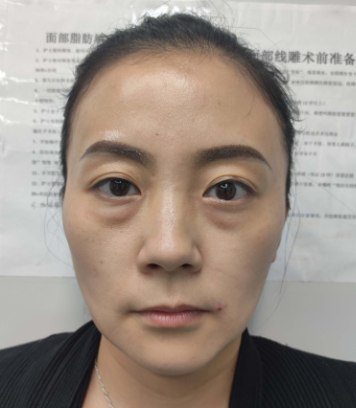 去眼袋手术