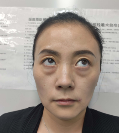 去眼袋手术