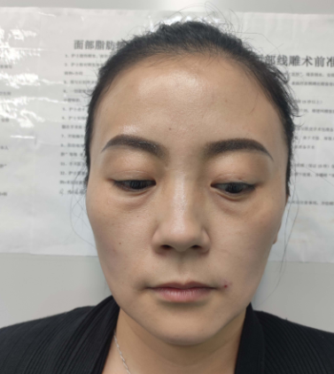 去眼袋手术