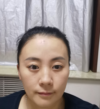 去眼袋手术