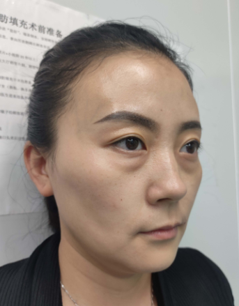 去眼袋手术