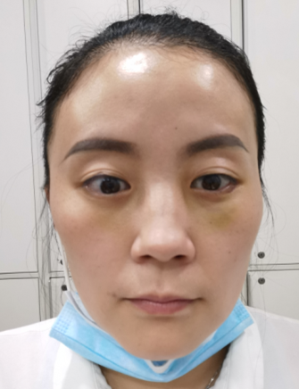 去眼袋手术