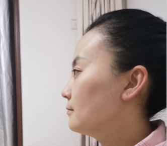 去眼袋手术