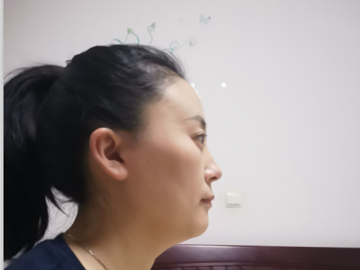 去眼袋手术