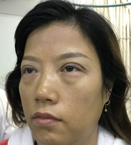 去眼袋手术