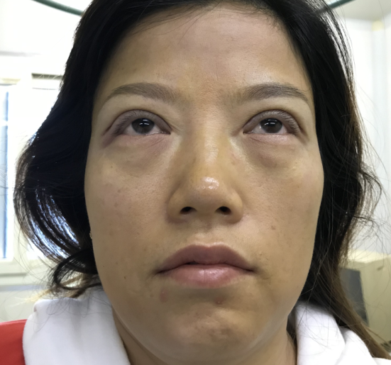去眼袋手术