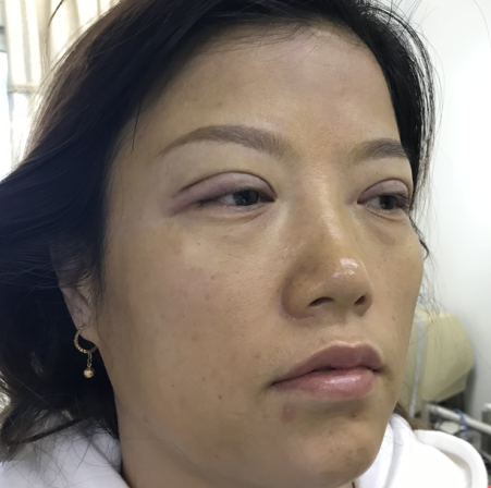 去眼袋手术