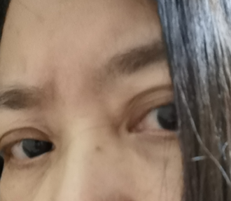 去眼袋手术