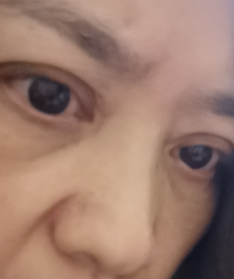 去眼袋手术