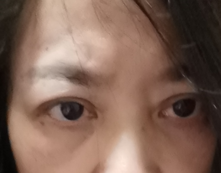 去眼袋手术
