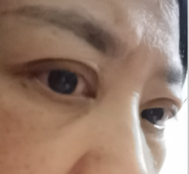 去眼袋手术