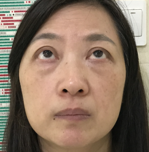 去眼袋手术
