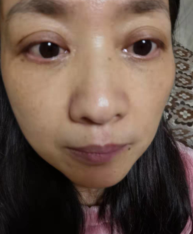 去眼袋手术