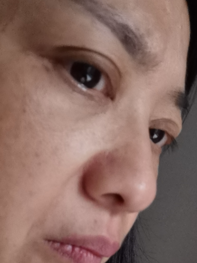 去眼袋手术