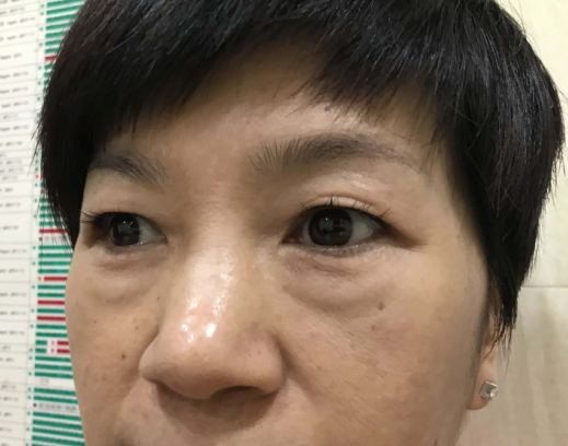 去眼袋手术