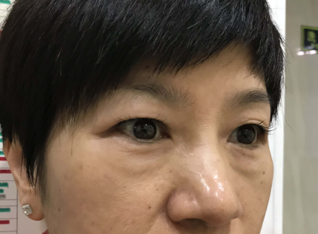 去眼袋手术