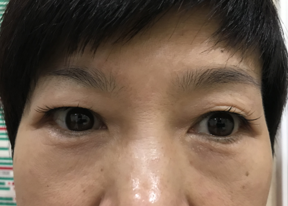 去眼袋手术