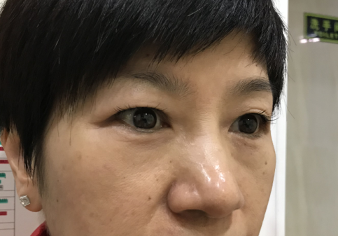 去眼袋手术