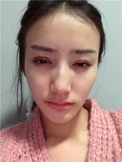 双眼皮手术