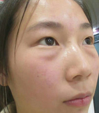 去眼袋手术