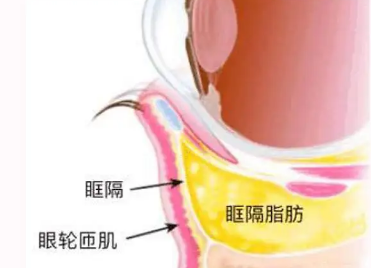 去眼袋手术