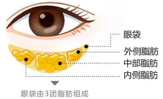 去眼袋手术