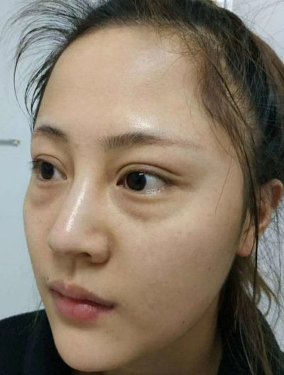 去眼袋手术