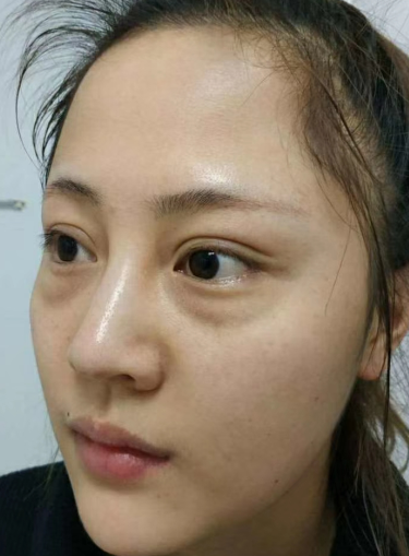 去眼袋手术
