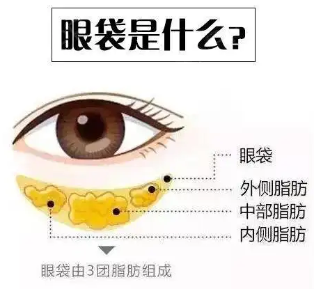 去眼袋手术