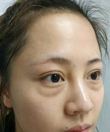 去眼袋手术