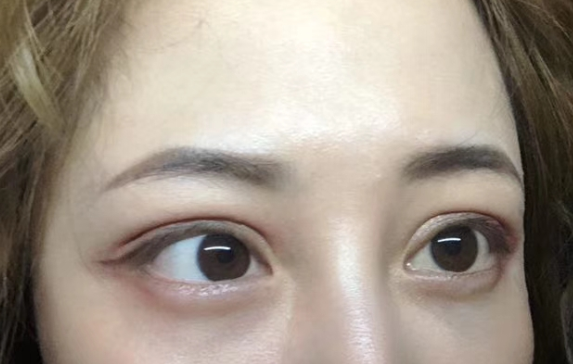 去眼袋手术