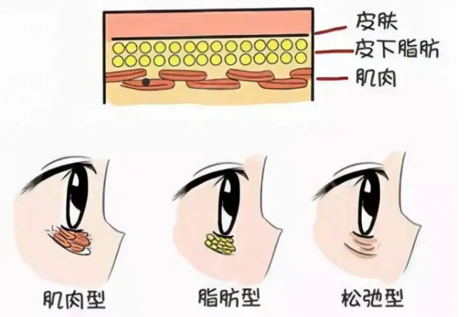 去眼袋手术